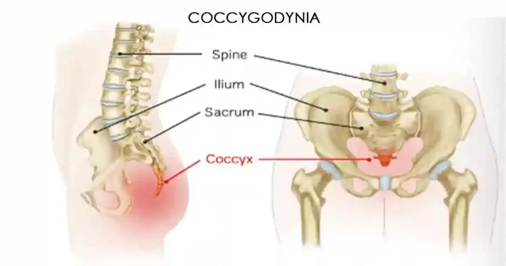 How to Avoid Tailbone Pain From Sitting at Desk